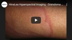 Granuloma Annulare video thumbnail